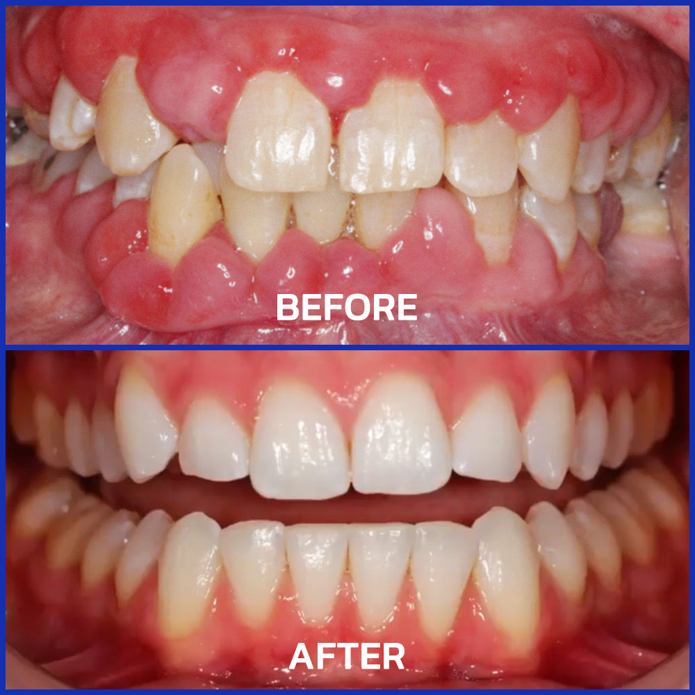 đĽFurzero⢠EaseSmile Gums Therapy & Pain Relief Probiotics Bee Venom Chicles (đŚđşADA Proven) BLIS K12 & M18, Fights Periodontitis, Gingivitis, Gum And Teeth Pain, Gum Recession, Inflammation, Tartar, Strep Throat