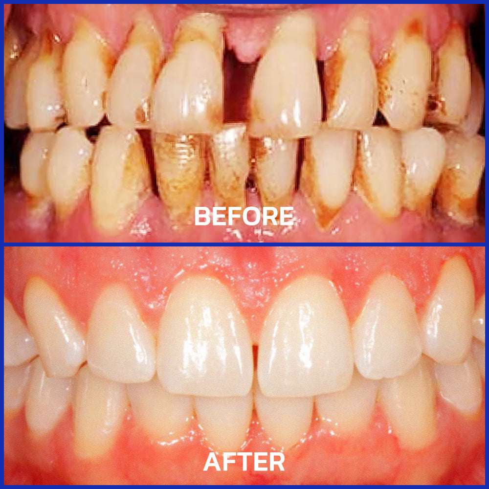 đĽFurzero⢠EaseSmile Gums Therapy & Pain Relief Probiotics Bee Venom Chicles (đŚđşADA Proven) BLIS K12 & M18, Fights Periodontitis, Gingivitis, Gum And Teeth Pain, Gum Recession, Inflammation, Tartar, Strep Throat