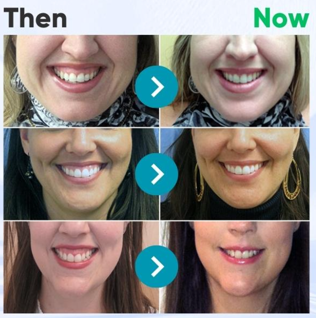 đĽFurzero⢠EaseSmile Gums Therapy & Pain Relief Probiotics Bee Venom Chicles (đŚđşADA Proven) BLIS K12 & M18, Fights Periodontitis, Gingivitis, Gum And Teeth Pain, Gum Recession, Inflammation, Tartar, Strep Throat