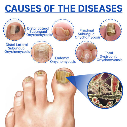 Furzero™ PureNail Fungus Laser Therapy Device