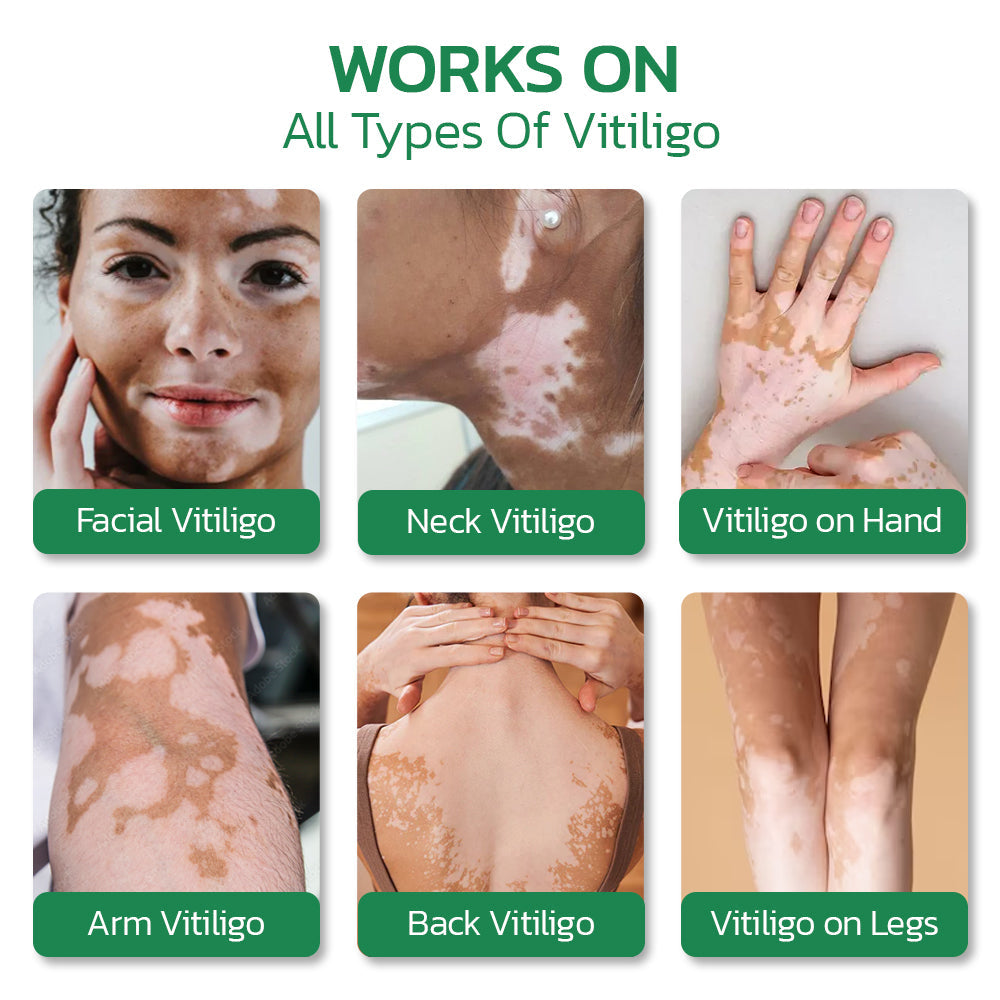 GFOUK™ VitiligoHeal Soothing Cream