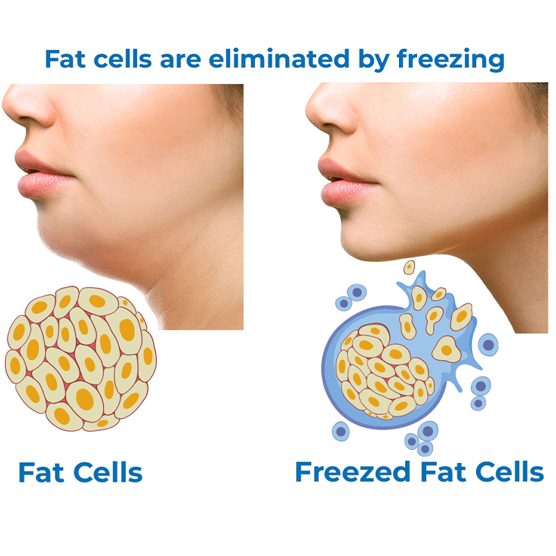 GFOUK™ Anti-glycation CoolSculpting Mask