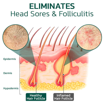 GFOUK™ Scalp Folliculitis Therapy Oil