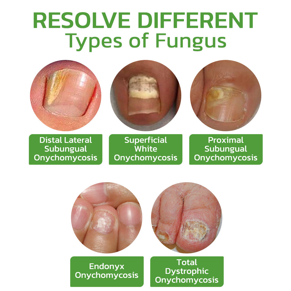 GFOUK™ 5 Days Nail Growth and Hardening Repair Roller