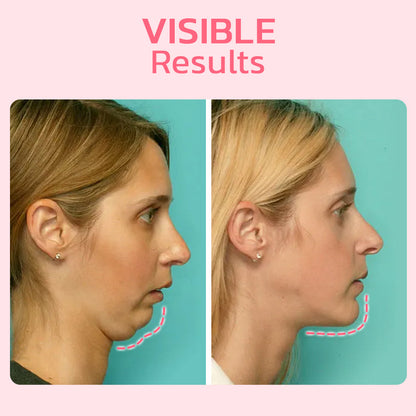 flysmus™ V Face Suction Beauty Trainer